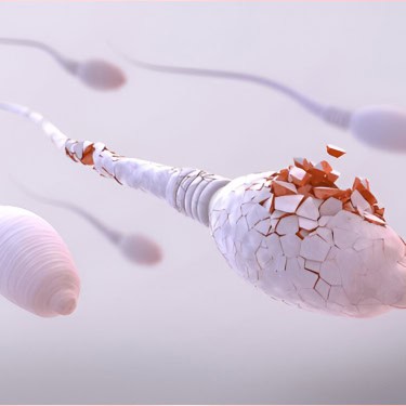 IUI –Intrauterine Insemination or Artificial Insemination (AI)